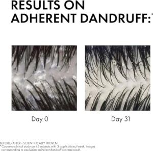 Anti Dandruff Kuru Saçlar Için Kepek Karşıtı Şampuan 200 ml